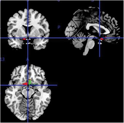 Sex differences in olfactory cortex neuronal loss in aging